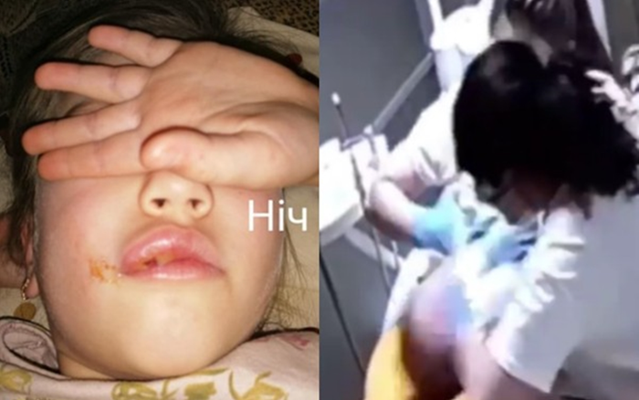 Vết sưng môi của bé gái 6 tuổi phơi bày cảnh phẫn nộ ở phòng khám nha khoa