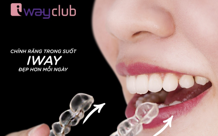 Công nghệ niềng răng trong suốt tại iWay Club cho nụ cười luôn xinh tươi