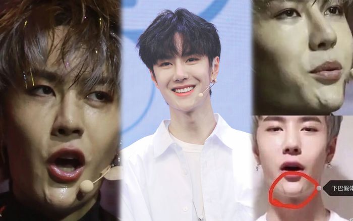 Nhan sắc Vương Nhất Bác lại gây tranh cãi vì bị nghi ngờ gặp biến chứng phẫu thuật thẩm mỹ