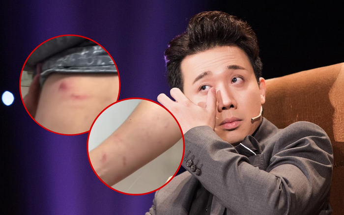 Trấn Thành khóc ròng vì bị khán giả cào đến rách da chảy máu