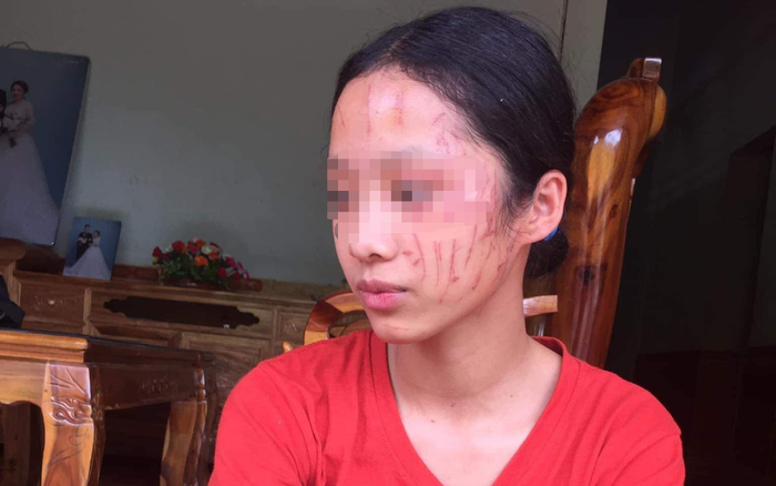 Thông tin từ phòng GD&ĐT về vụ nữ sinh lớp 8 ở Nghệ An bị cào xước mặt