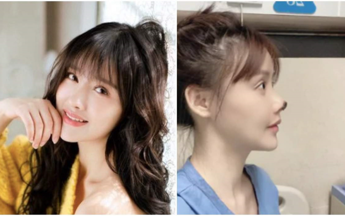 Nữ diễn viên hoại tử mũi hậu dao kéo, bác sĩ thẩm mỹ bị đình chỉ công tác