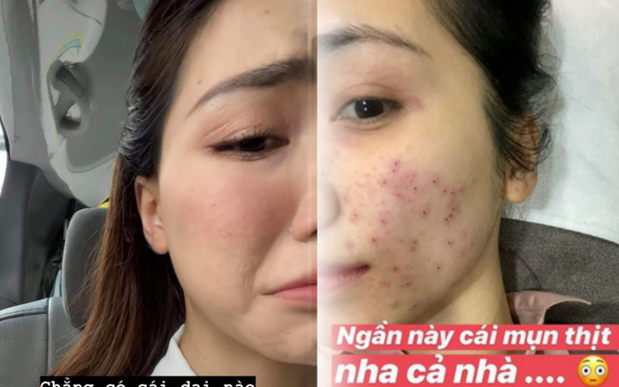 Hoà Minzy lộ da bong tróc từng mảng lớn như bà già, chuyện gì đã xảy ra?