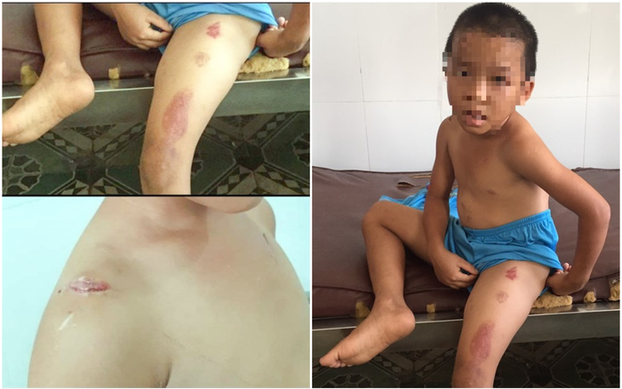 Bé trai 6 tuổi ở Sóc Trăng bị cha dượng gây thương tích, dùng thuốc lá đang cháy châm vào cơ thể