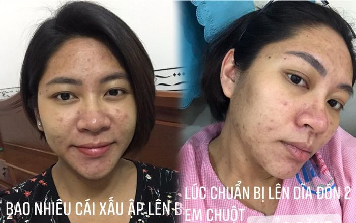 Hoa hậu Đại dương Đặng Thu Thảo khiến dân tình 'phát hoảng' với gương mặt mọc đầy mụn