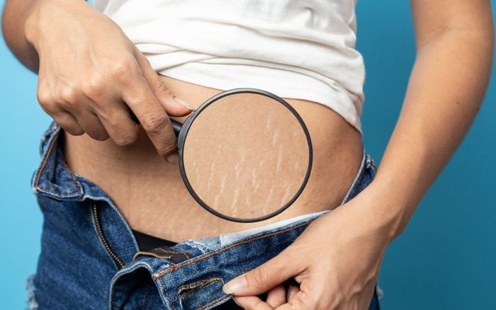 6 cách đơn giản cực hiệu quả giúp bạn loại bỏ vết rạn da xấu xí