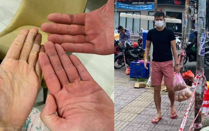 Công Vinh khoe bàn tay đỏ lòm vì phụ Thủy Tiên đi hỗ trợ vùng dịch, nào ngờ vẫn bị mỉa mai