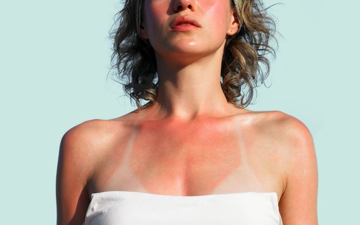 8 thói quen sai lầm khiến làn da cháy nắng càng thêm bong tróc, phồng rộp