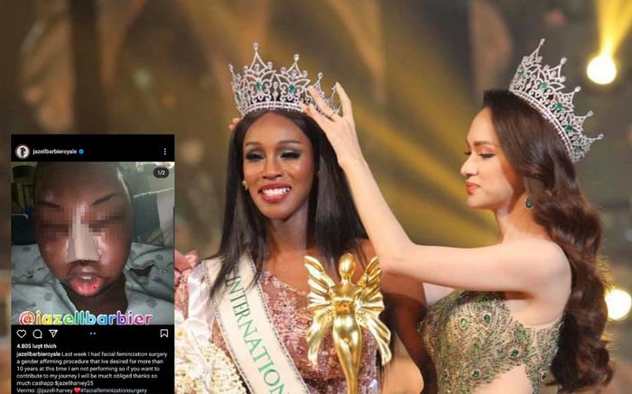 Hoa hậu chuyển giới kế nhiệm Hương Giang đại phẫu khuôn mặt, kết thúc 10 năm bị chê cười?