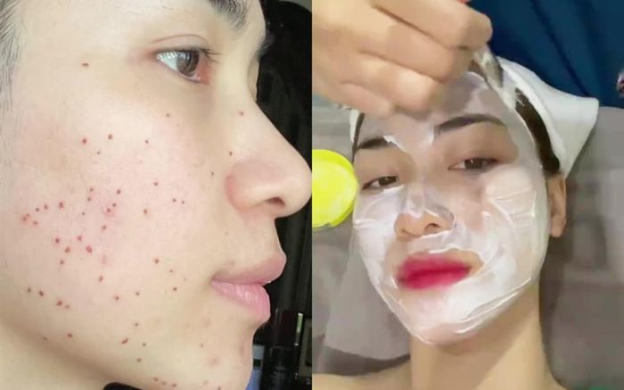 Hoà Minzy lộ gương mặt sẹo chi chít đến phát sợ, hoá ra đây là một phương pháp làm đẹp