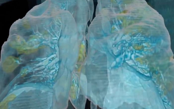 Phổi bị tổn thương do Covid-19 trông đáng sợ thế nào?