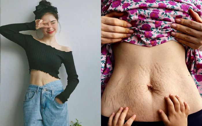 Mẹ bỉm sữa Hòa Minzy chia sẻ quá trình xóa rạn da sau sinh