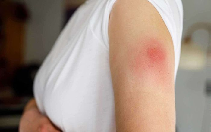 Những người 'dị ứng nghiêm trọng' phản ứng như thế nào sau khi tiêm vaccine Covid-19?