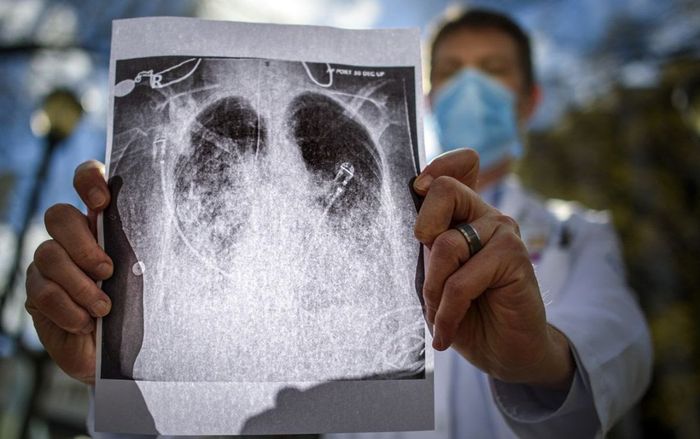 Tổn thương phổi 85% vì Covid-19, người đàn ông làm nên kỳ tích sau 2 tháng