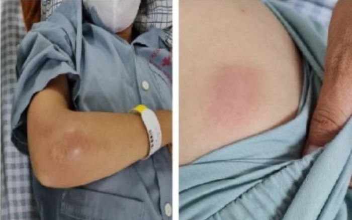 Cô gái sưng đau 'vòng một' đi cấp cứu tại bệnh viện được phát hiện bị 'vi khuẩn ăn thịt người' tấn công