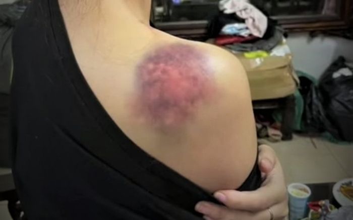 Truy tìm gã chồng bạo hành vợ xuyên đêm gây thương tích khắp cơ thể