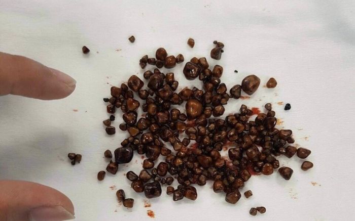 Bị đau bụng 3 ngày không hết, nữ bệnh nhân nhập viện thì được phát hiện hơn 200 viên sỏi trong túi mật