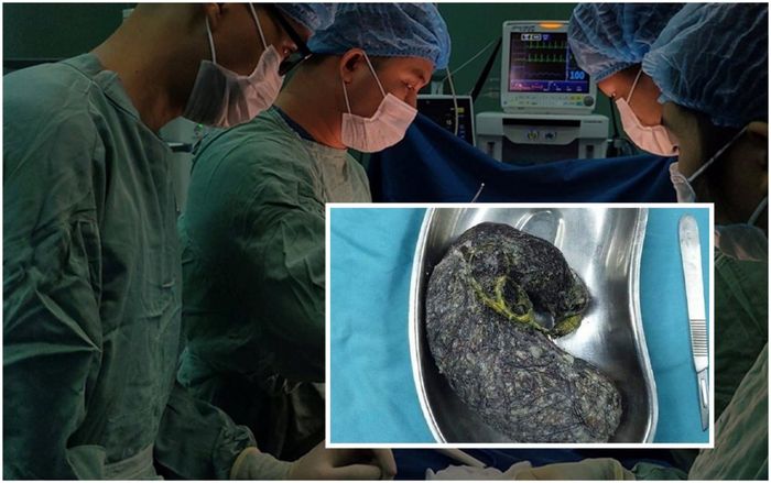 Búi tóc nặng nửa ký nằm trong dạ dày bé gái 7 tuổi ở Quảng Ngãi