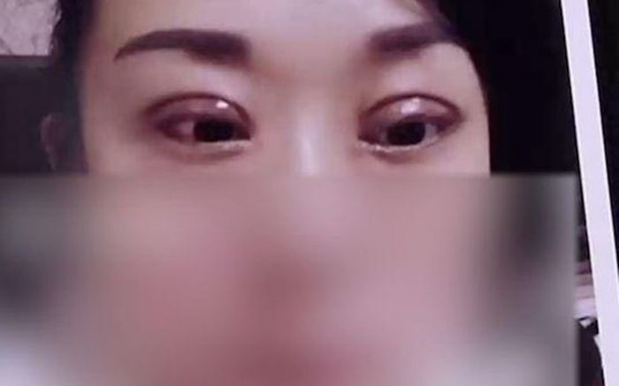 Thẩm mỹ để 'đổi phong thủy cho chồng', cô vợ 'khóc thét' với gương mặt mình sau 2 năm