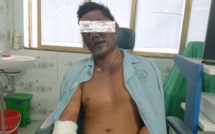 Một người nhập viện trong tình trạng bỏng nặng do đang ăn lẩu thì bình gas phát nổ