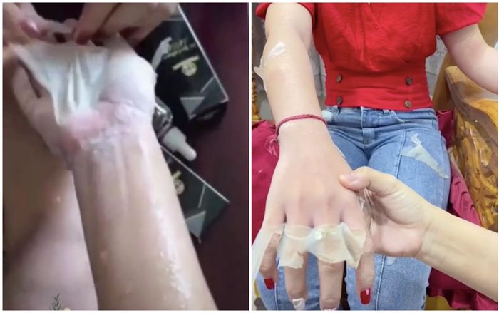 Kinh hãi trước các màn lột da viral trên mạng có tên gọi mỹ miều 'thay da collagen', 'lột da sinh học'
