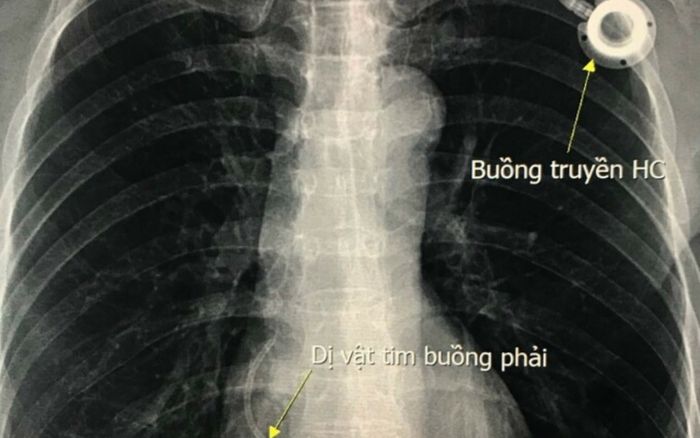 Người phụ nữ bị dị vật trôi theo mạch máu rồi mắc kẹt ở tim