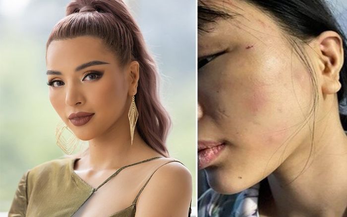 Sau khi tố chồng chưa cưới bạo hành dã man, Khả Trang hé lộ thêm tình trạng đáng lo của bản thân