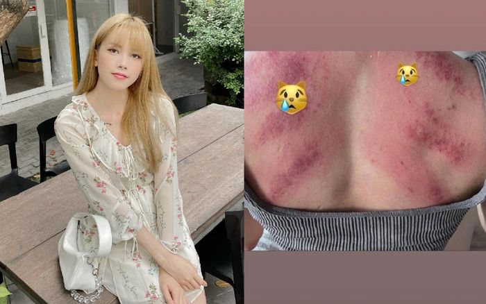 Thiều Bảo Trâm khiến netizen hoang mang khi để lộ cơ thể chi chít vết đỏ bầm