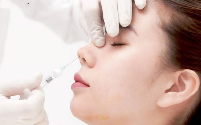 Cô gái hoại tử da mặt sau khi tiêm filler nâng mũi tại một cơ sở làm đẹp