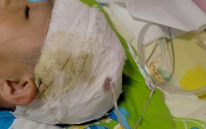 Nam sinh 10 tuổi nhập viện trong tình trạng vỡ mạch máu não sau khi bị thầy Hiệu trưởng đánh ở trường