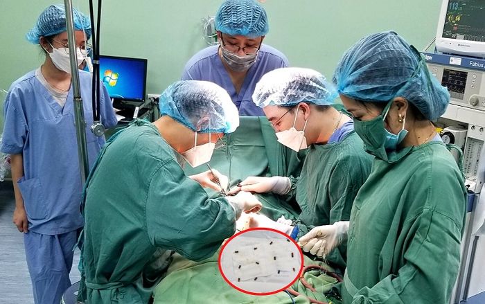 Bé trai 37 tháng tuổi, nuốt phải 25 viên bi nam châm được cấp cứu kịp thời