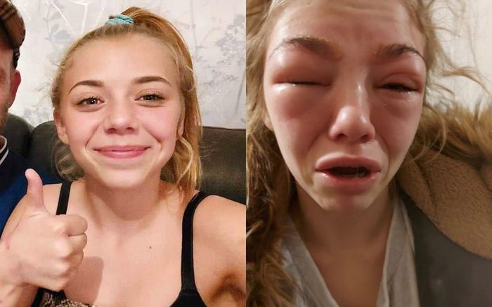 Cô bé 14 tuổi suýt mất mạng vì ham nhuộm lông mày, nối mi