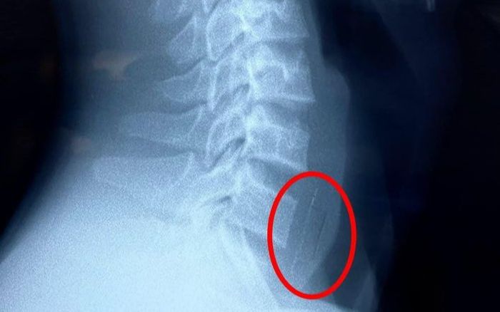 Bé trai 13 tuổi nuốt cả viên thuốc hạ sốt còn nguyên vỏ sắc nhọn