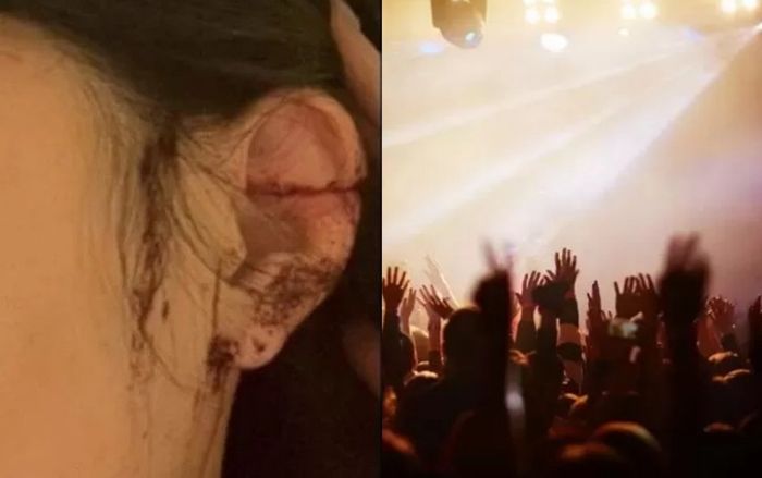 Đi vũ trường qua đêm, cô gái say xỉn bị cắt tai, diễn biến vụ việc gây sốc đến khó hiểu