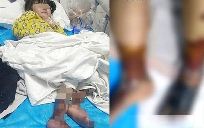 Bé gái 4 tuổi bị dì ghẻ bạo hành, dùng kim châm vào cơ thể, rót nước sôi vào người gây chấn động TQ