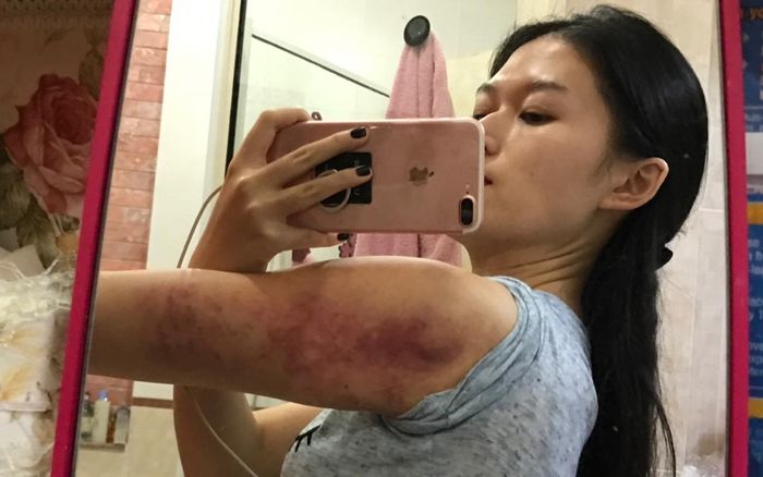 Một sao nữ 'bầm mình' vì giảm cân sai phương pháp