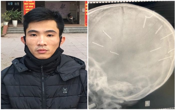 Hà Nội hoả tốc chỉ đạo vụ bé gái 3 tuổi bị bạo hành với 9 dị vật trong sọ não nghi là đinh