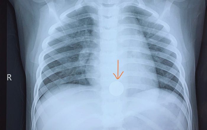 Cứu sống bé trai 5 tuổi mắc dị vật pin cúc áo, bác sĩ đưa ra lời khuyên đáng lưu ý cho bố mẹ