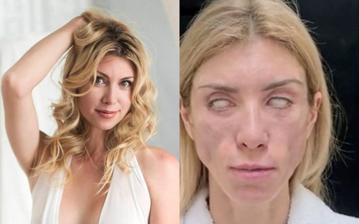 Nàng Á Hậu nghiện PTTM rồi gánh chịu hậu quả mặt cứng đơ, mắt trợn ngược