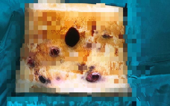 Làm đẹp quá đà, cô gái 'thủng bụng' vì thuốc tan mỡ bụng