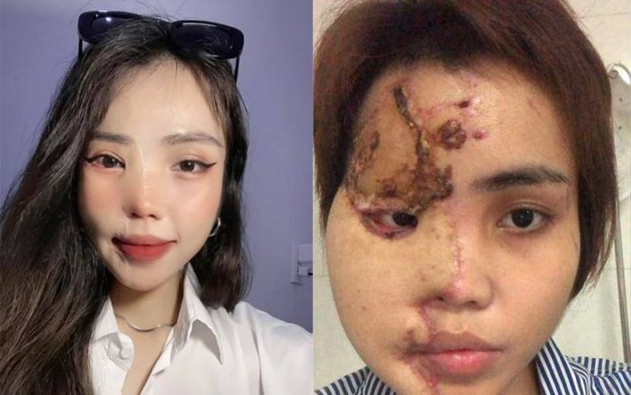Sau 3 năm, cô gái bị chồng sắp cưới tạt axit giờ ra sao?
