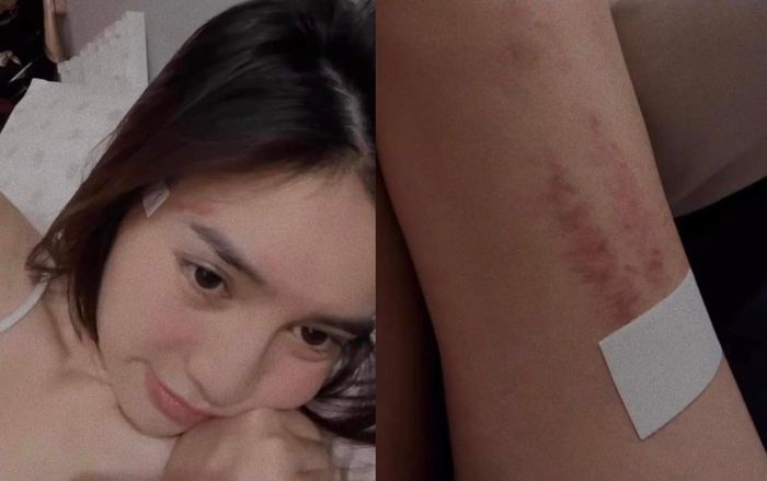 Lan Ngọc xuất hiện với hình ảnh tay chân bầm dập, mặt phờ phạc, chuyện gì đây?