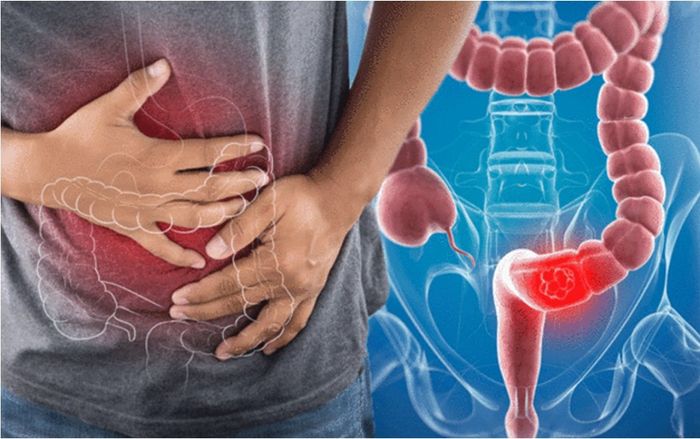 Triệu chứng 'cờ đỏ' của ung thư ruột bạn cần đi khám ngay lập tức