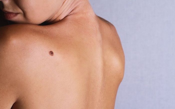 4 nốt ruồi tài lộc kém, phá hủy vận may, ai sở hữu cả đời vất vả bôn ba