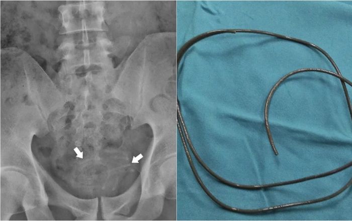Nhét dây tai nghe vào niệu đạo để tạo khoái cảm, nam thanh niên gặp cái kết đau đớn