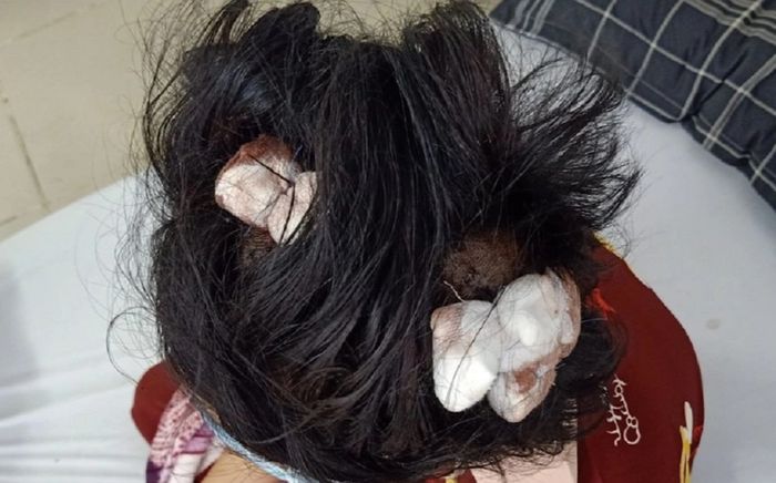 Thiếu nữ 16 tuổi bị cha dượng đánh dập lá lách, gãy xương sườn