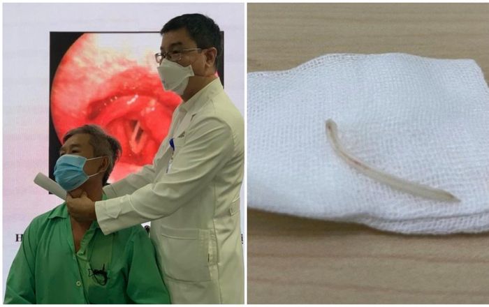 Người đàn ông bị xương cá diêu hồng cắm vào dây thanh quản do giật mình khi đang ăn