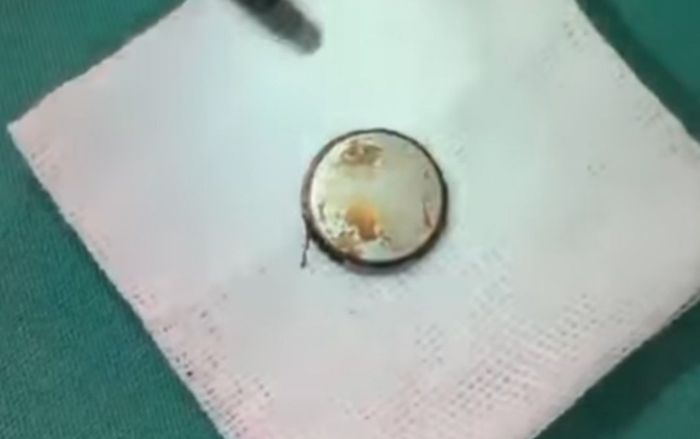 Bé 3 tuổi quấy khóc, nôn mửa được gia đình đưa vào bệnh viện, phát hiện một vật trong thực quản