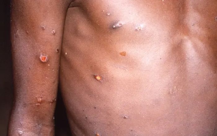 Bệnh đậu mùa khỉ lây lan thế nào, triệu chứng và nguy hiểm ra sao?