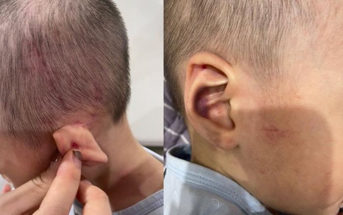 Làm rõ vụ việc bé 2 tuổi tại trung tâm giáo dục chuyên biệt có nhiều vết bầm trên người
